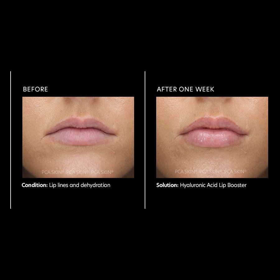 Hyaluronic acid lip booster