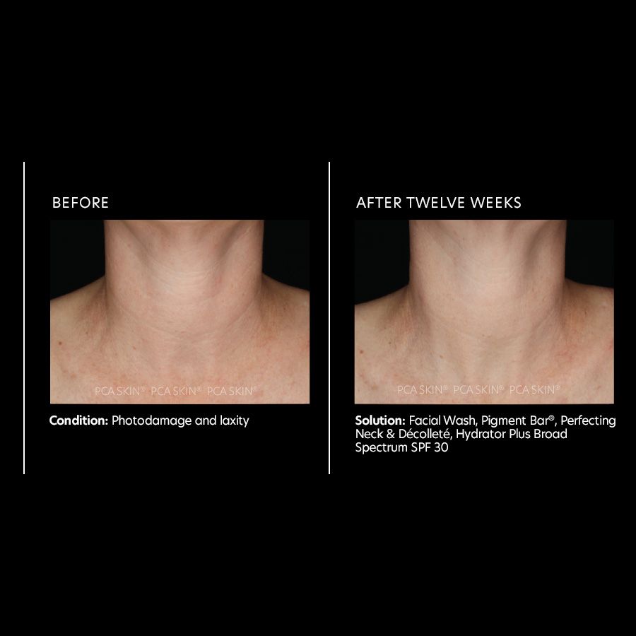 Perfecting neck & décolleté